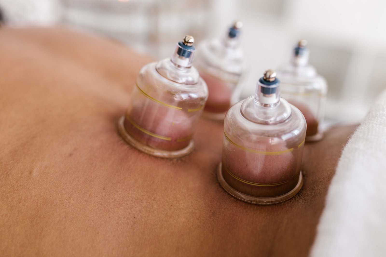 cupping